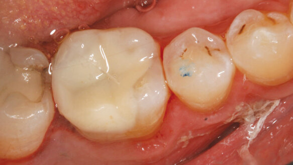 Crown or same-day onlay?