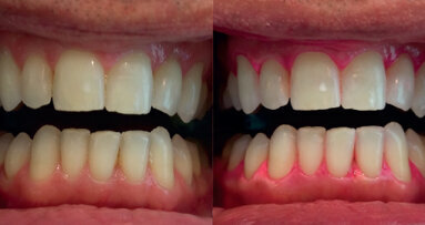 Analisi dei risultati ottenuti con un trattamento sbiancante post igiene