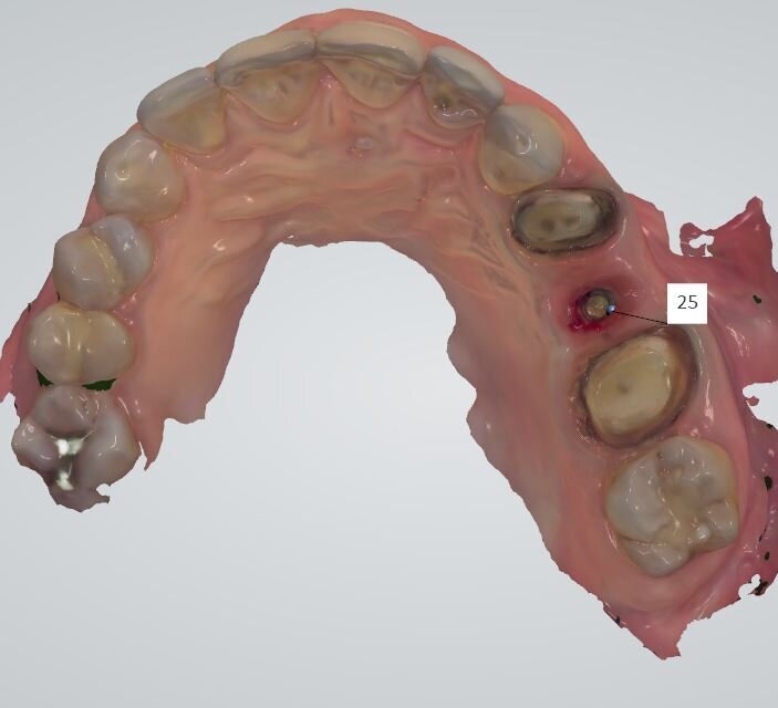 Fig. 7 - La schermata dell’impronta rilevata con sistema IOS Trishape.