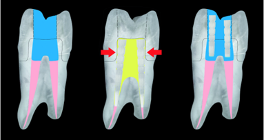 Rationale for the suggested use of fibre post segments in composite core build-ups for endodontically treated teeth