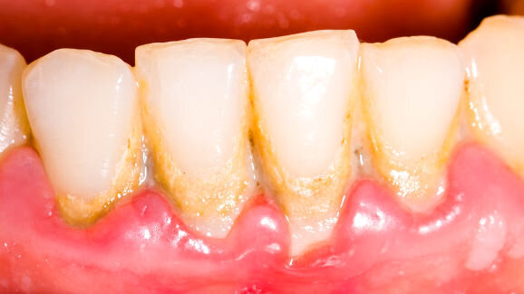 Novos dados confirmam a ligação entre gengivite e doenças sistêmicas