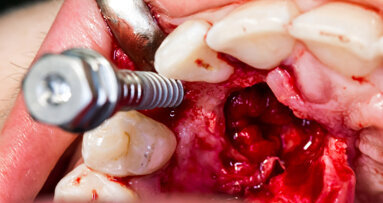 Nano-coating effective in reducing peri-implantitis risk