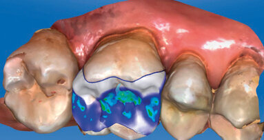 Restauri protesici singoli eseguiti con metodica CAD/CAM chairside
