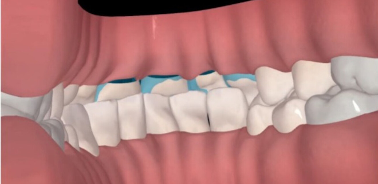 Figs. 3a & b: Side-by-side lingual view of the pre- (a) and post-alignment ClinCheck images (b) with restorative overlay displaying orthodontic space creation for the restorative and prosthodontic phase of treatment. 