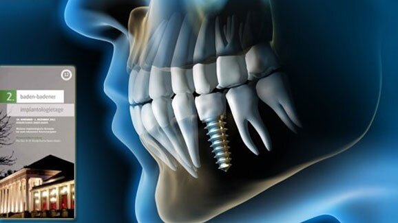 Konzepte bei stark reduziertem Knochenangebot