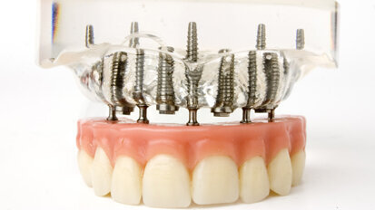 Vier implantaten volstaan voor klikgebit