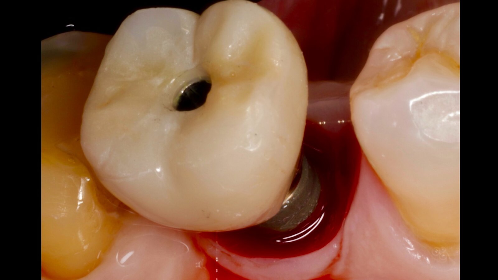 Interacción entre factores protésicos y sistémicos en la periimplantitis 