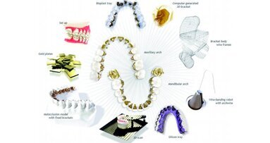 Traitement sans extraction d’un cas de classe II présentant une agénésie de l’incisive centrale mandibulaire au moyen d’un système de CFAO d’orthodontie linguale