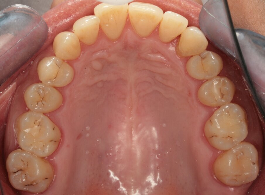 Fig.1_Visione occlusale dell’arcata superiore.