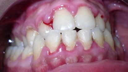 Valutazione clinica  degli effetti del prodotto a base di aminoacidi combinato con sodio jaluronato (aminogam) in pazienti sottoposti a igiene orale professionale