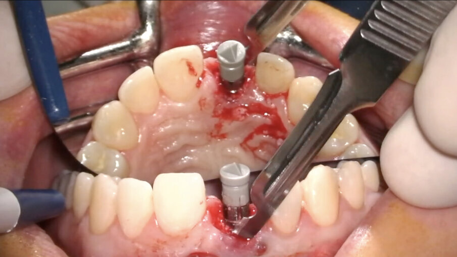Fig. 15_Incisione verticale per la creazione della tasca mucosa a spessore parziale.