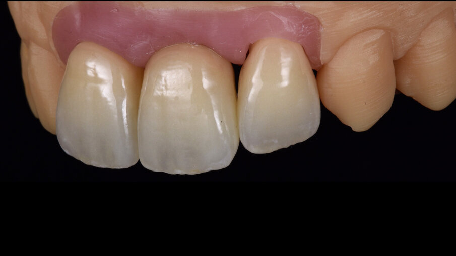 Figg. 12-14_Aspetto finale delle corone dopo le fasi di lucidatura meccanica.