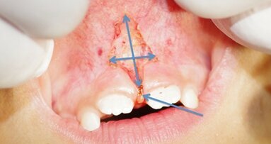 Frénectomie labiale supérieure