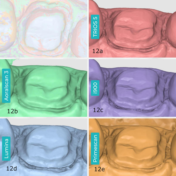 Figs. 12a–e: Preparation margins captured by each intra-oral scanner. TRIOS 5 (a). Aoralscan 3 (b). Medit i900 (c). ITero Lumina (d). CEREC Primescan (e).