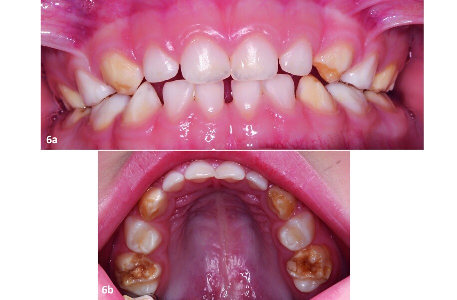 Figs. 6a y b: La hipomineralización de los segundos molares temporales puede asociarse con un mayor riesgo de MIH en la dentición permanente.