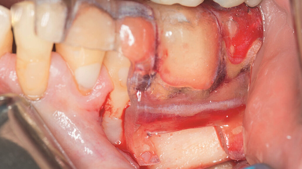 Target endodontic microsurgery