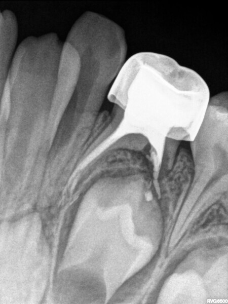 Fig. 17 : Contrôle à 30 mois.