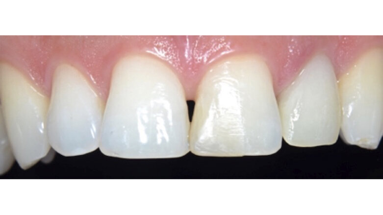 Resinas Compuestas: Estado Actual