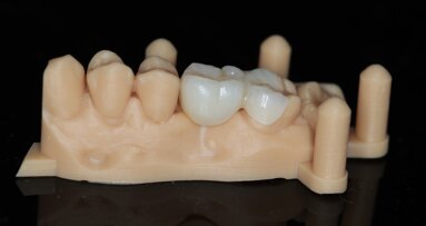Casus: De posterior cantilever adhesiefbrug