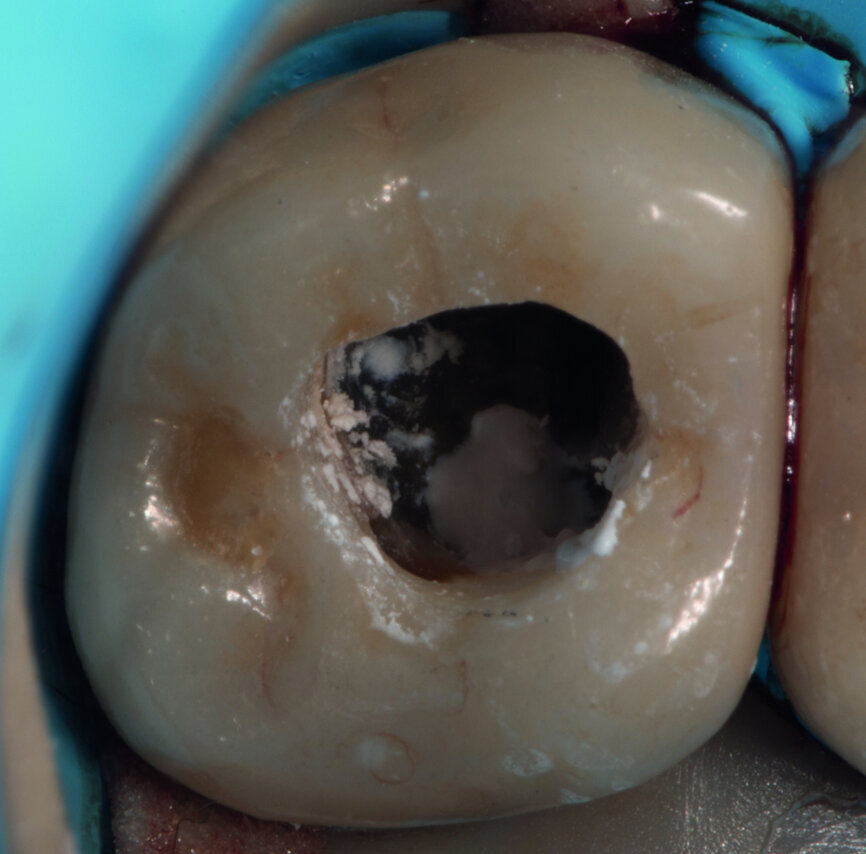 Fig. 3 : La perforation a été fermée avec un ciment hydraulique à base de silice.