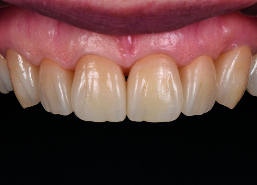 Fig. 10b : Résultat hautement esthétique et fonctionnel. 