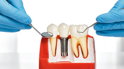 Lebenslang gesunde Zahnimplantate - Wunsch oder Wirklichkeit? Lebenslang gesunde Zahnimplantate - Wunsch oder Wirklichkeit?