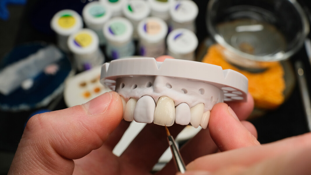 Fig. 19: Adaptation of the incisal third using a mamelon-effect mixture of CERABIEN ZR internal stain shades (White, Mamelon Orange and Bright).