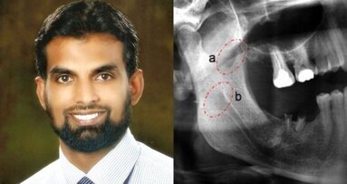 Discovery of 'Coronoid Foramen' by a Bengaluru surgeon Dr Nyer Firdoose could explain pain after LA