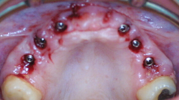 Quick and easy prosthetic planning