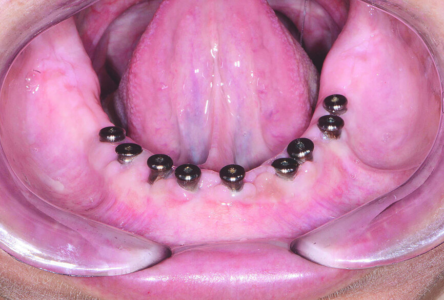 Fig 18 Crête mandibulaire quatre mois après l’intervention