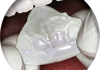 NiteBite targets bruxing