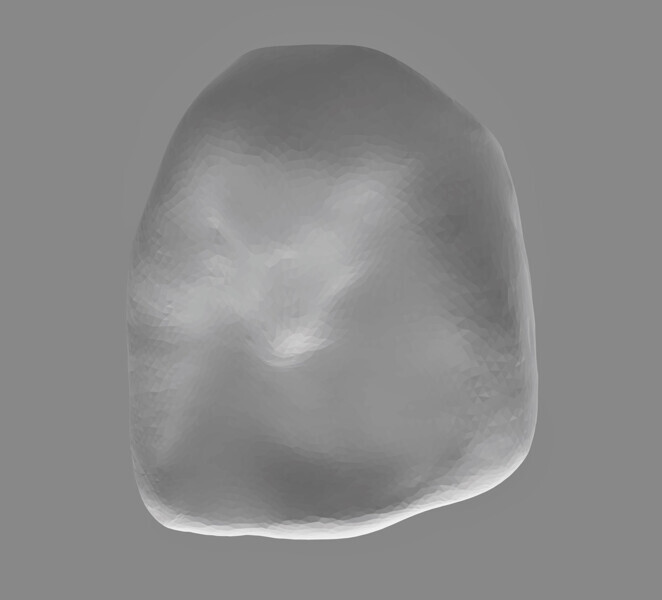 Fig. 2: Design for crown for tooth #11, lingual view.