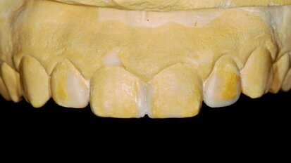 Amélioration du plan de traitement esthétique et de la communication grâce au mock-up diagnostique