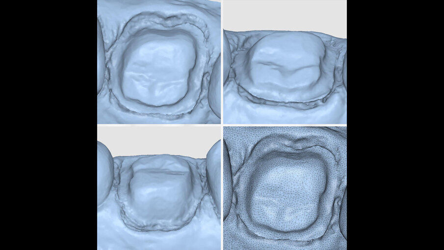 Fig. 9 - Scansione dei margini di preparazione con iTero Lumina.