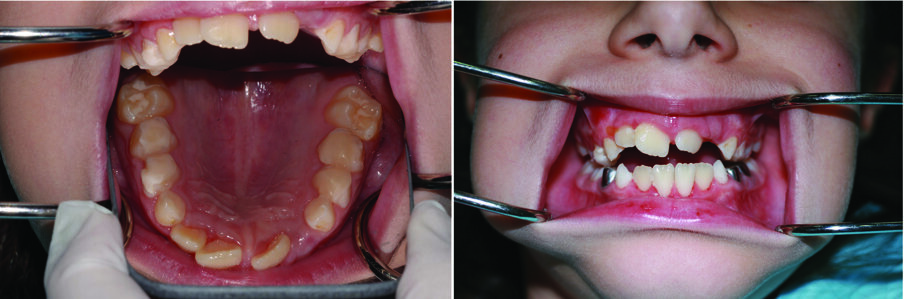 Fig. 15 (a & b). GIC build ups on LT’s upper primary molars to open the bite 