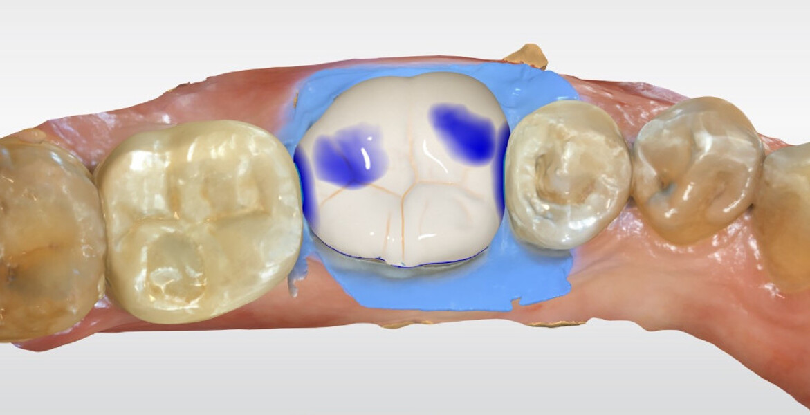 Fig. 19c: CAD workflow for tooth #36: preview of the endocrown design.