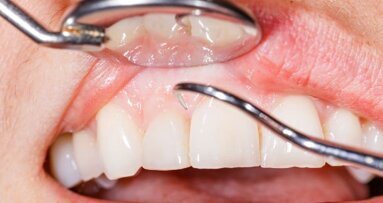 As profundidades de sondagem colocam a saúde bucal em risco