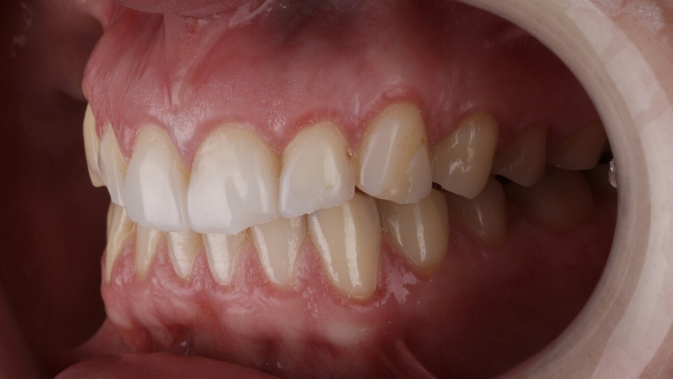 Fig. 1g: Right lateral intra-oral views with the teeth in intercuspation.