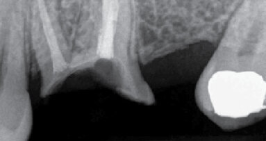 Význam endodoncie při plánování implantologické léčby