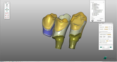 Aadva Lab Scan – vysoká  přesnost pro dokonalé náhrady