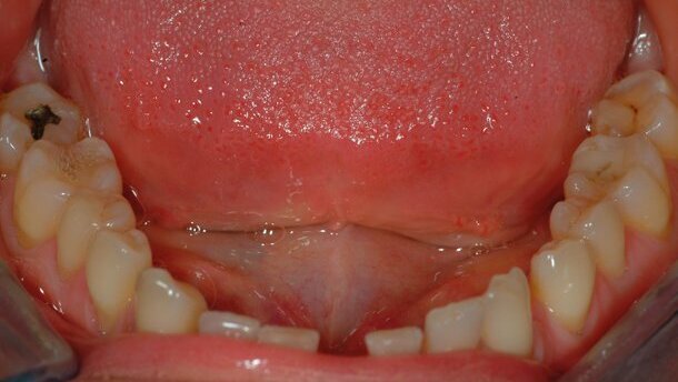 Estetica del sorriso: approccio interdisciplinare ortodonzia-implantologia – seconda parte