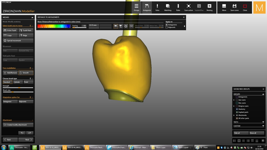 Fig. 7: Design of the CAD/CAM crown.
