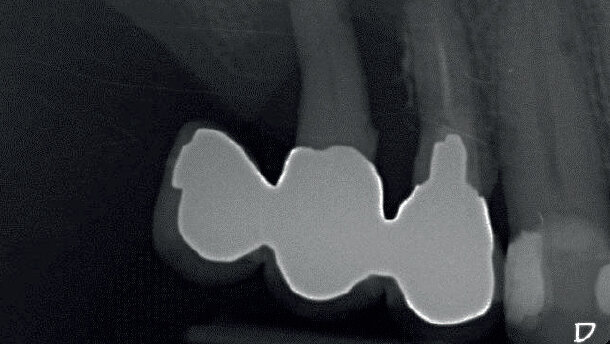Il Biopad® come coadiuvante emostatico nei processi di guarigione dell’alveolo post-estrattivo