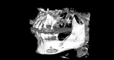 CBCT w diagnostyce i planowaniu leczenia nieswoistego przewlekłego zapalenia żuchwy – opis przypadku