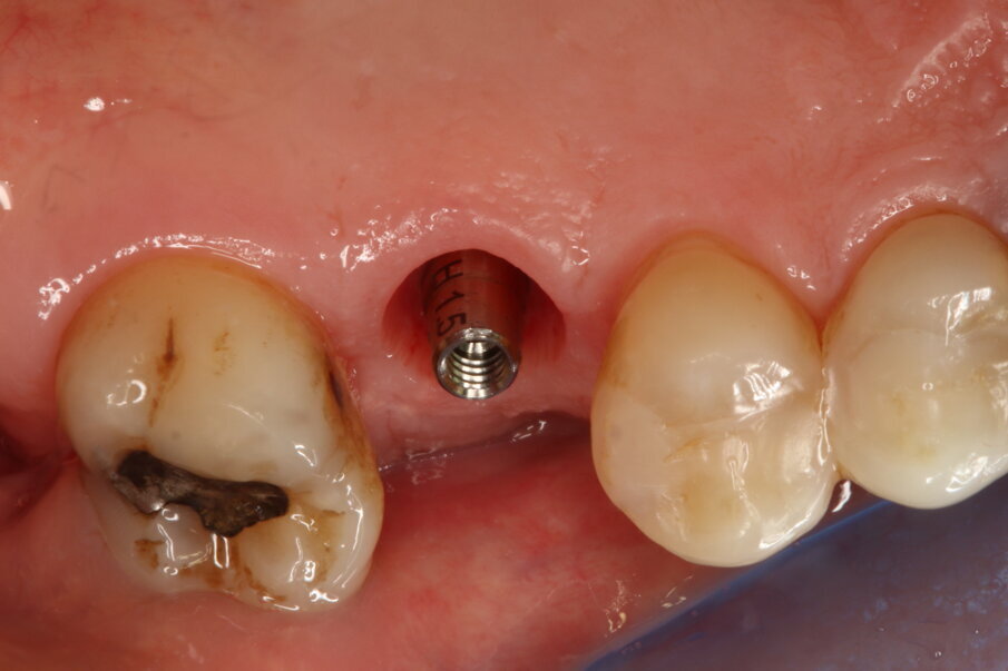 Fig. 8_Guarigione dopo 4 mesi.