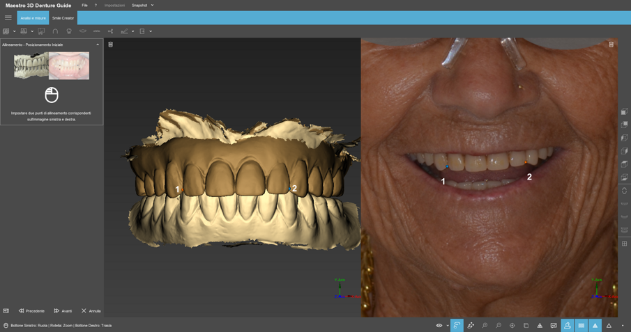 Fig. 9 - Passaggio dell’allineamento tra il File STL del rapporto intermascellare con la fotografia.