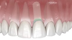 Symbionic Teeth : le remplacement dentaire avec barrière protectrice muqueuse