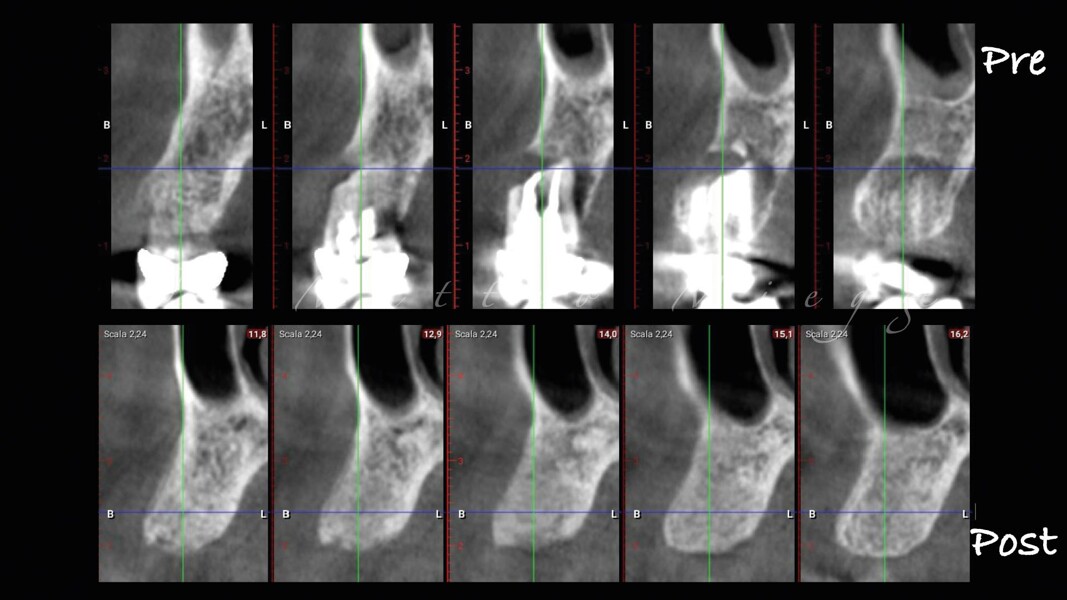 Fig. 10_CBCT pre-post.