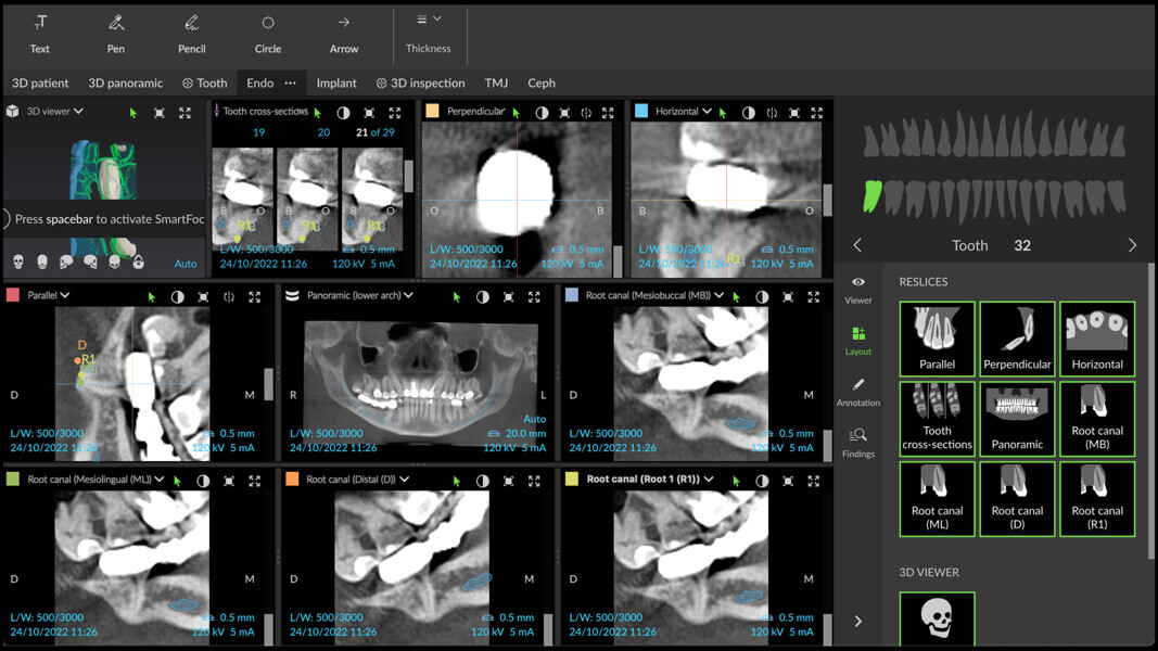 Fig. 14: Endodontic mode of DTX Studio Clinic showing different sections of the area and the relation between the mandibular canal, traced by the software, and the roots of the molar.