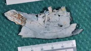 Forenzička odontologija – disciplina koja obuhvata više od identifikacije